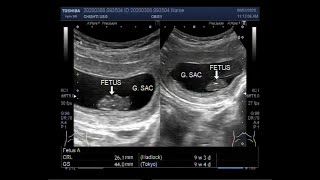 Ultrasound Video showing Missed abortion or Missed miscarriage [upl. by Telocin246]