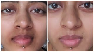 How I ACTUALLY got Rid of Pigmentation Around my Mouth  Pigmentation Treatment For Mouth Darkness [upl. by Ennaylloh]