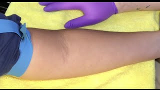 Tips For Locating Difficult Veins [upl. by Eda]